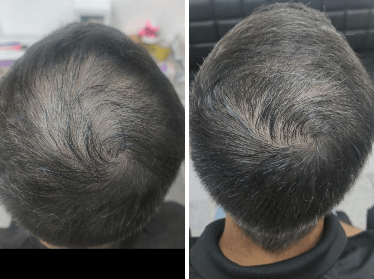 Antes del tratamiento