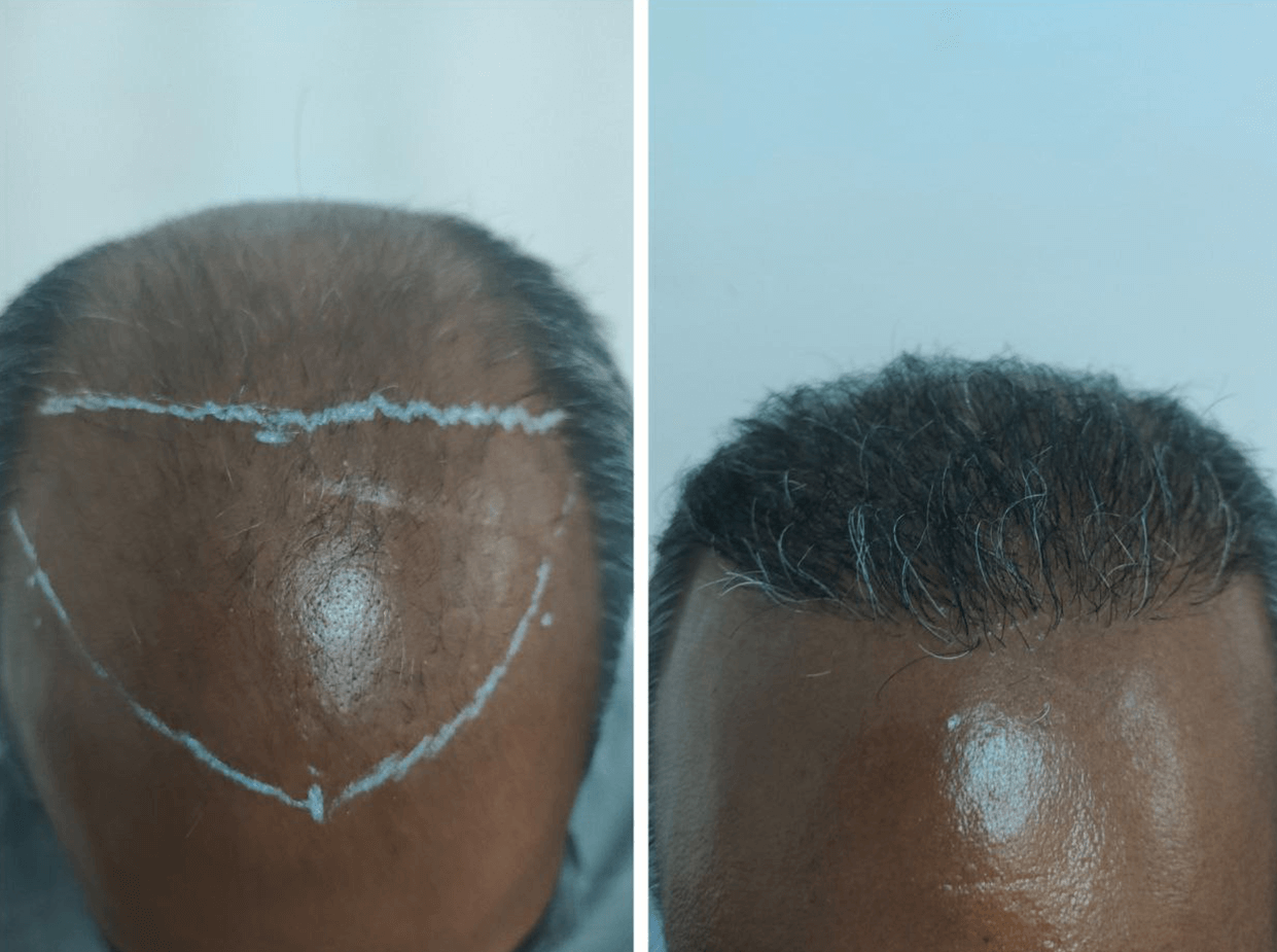 Después del tratamiento