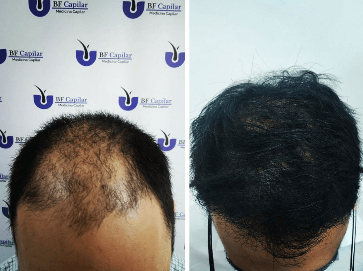 Antes del tratamiento