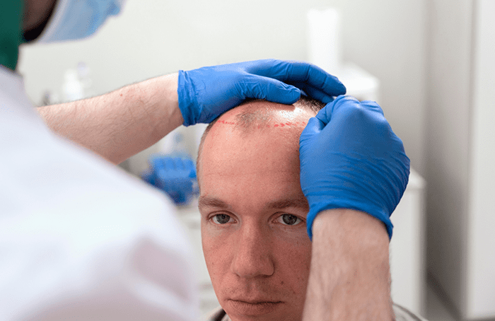 Micro implante capilar